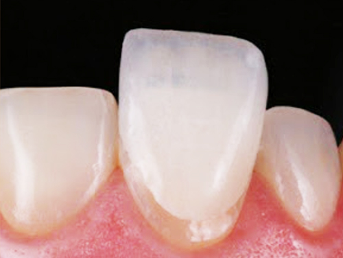 LENTE DE CONTATO/FACETA DENTAL