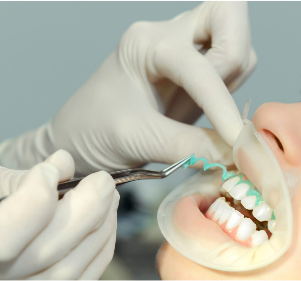 CLAREAMENTO DENTAL EM CONSULTORIO