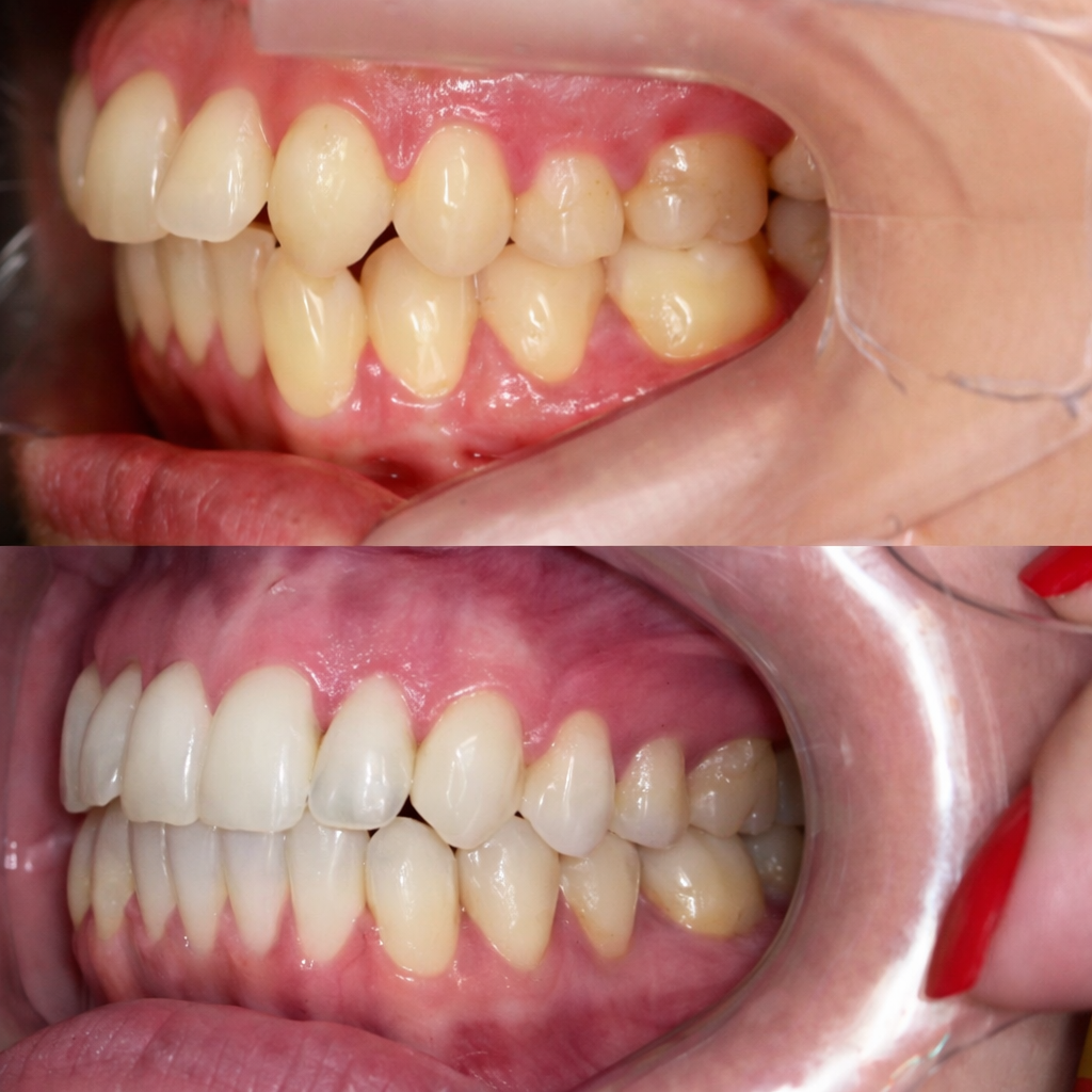 Antes e depois do sorriso saudável