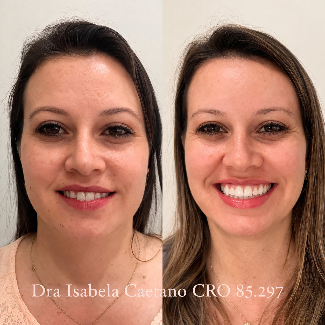 Antes e depois_ sorriso radiante